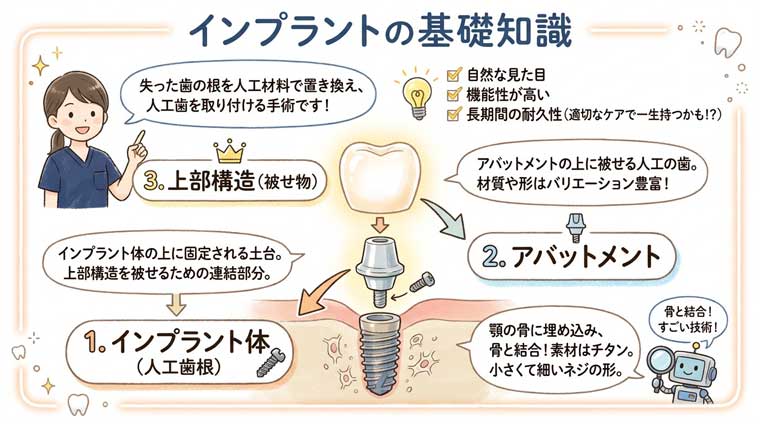 インプラントの基礎知識の図解