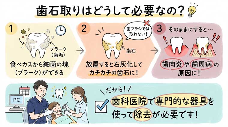 歯石取りはどうして必要なの?の図解