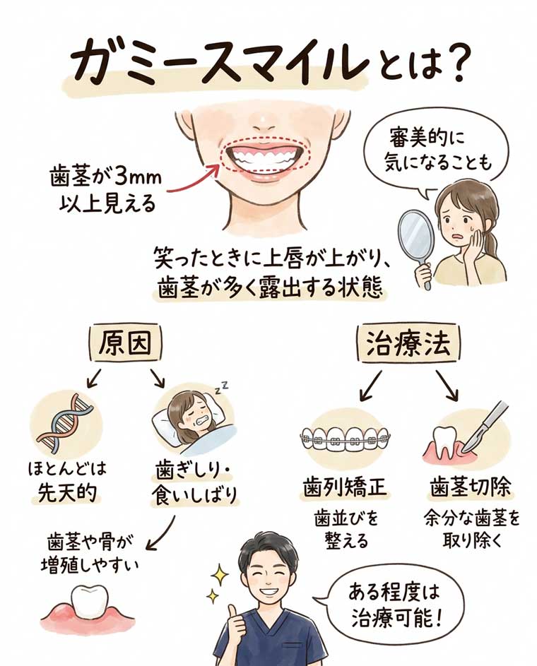 ガミースマイルとは？の図解