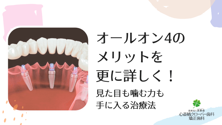 オールオン4のメリットを更に詳しく！