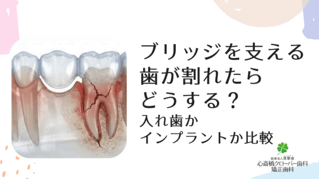 ブリッジを支える歯が割れたらどうする？入れ歯かインプラントか比較