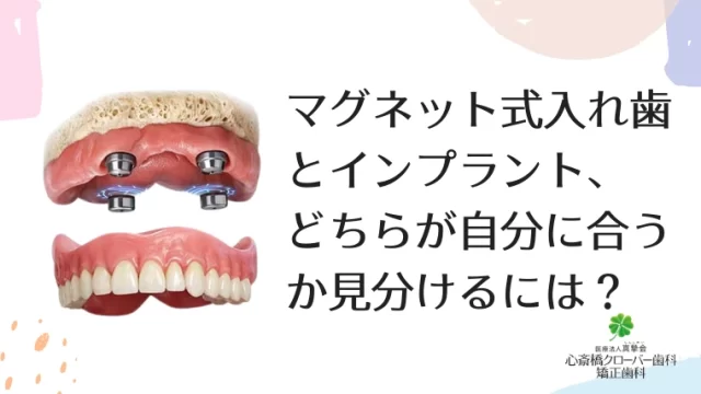 マグネット式入れ歯とインプラント、どちらが自分に合うか見分けるには？