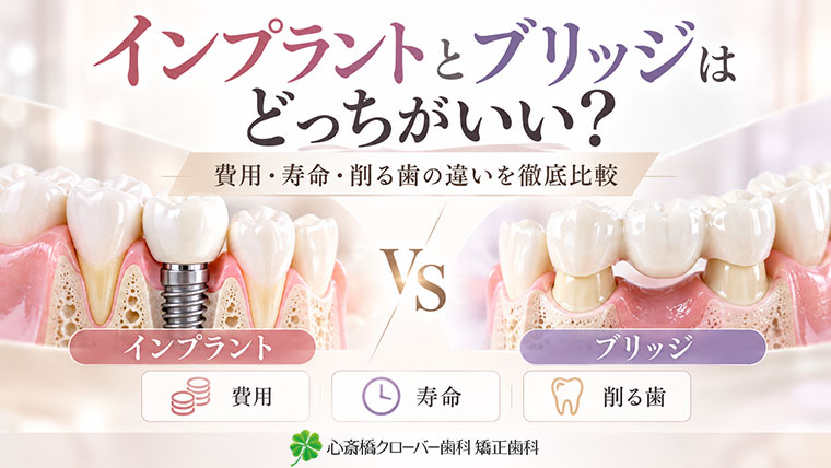 インプラントとブリッジはどっちがいい?費用・寿命・削る歯の違いを徹底比較