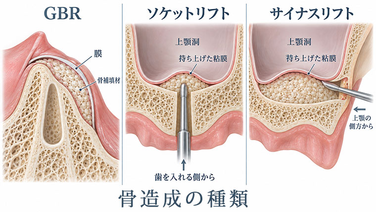 骨造成の種類