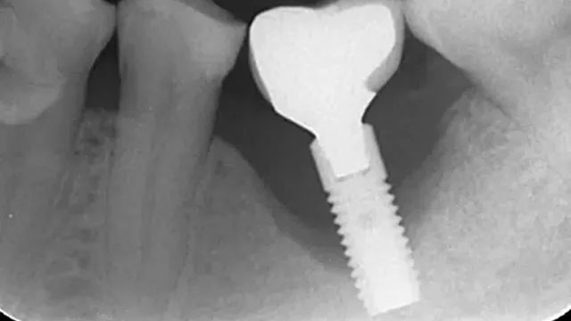 インプラント周囲炎