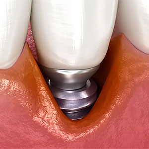 インプラント周囲炎