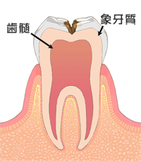 象牙質の虫歯の状態